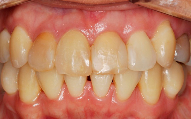 frontal-post-ortodoncia