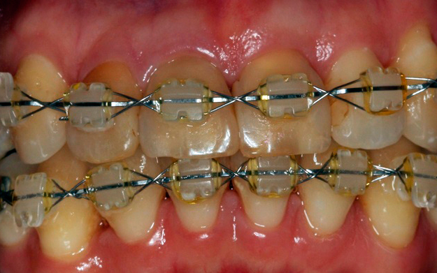 frontal-ortodoncia