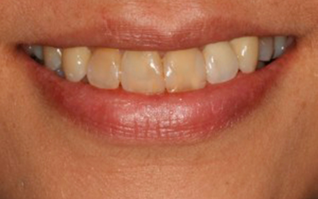 sonrisa-post-ortodoncia-300x225